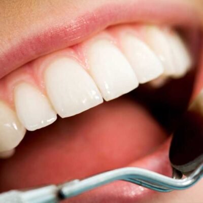 temporary veneers