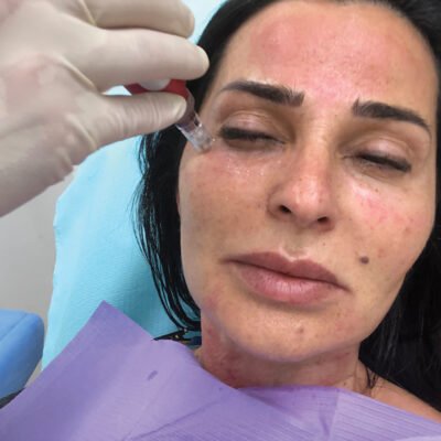 The Role of Microneedling in Anti-Aging Skin Care