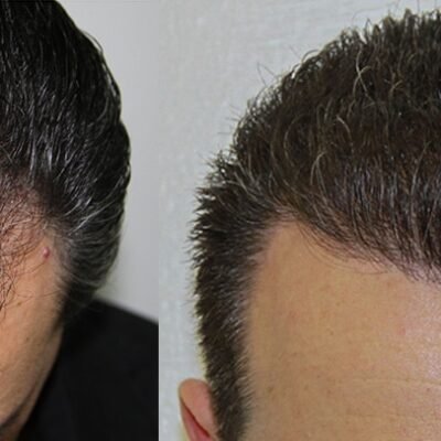 hair transplant in Delhi