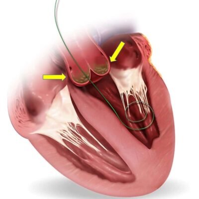 Transcatheter Aortic Valve Implantation (TAVI) Market