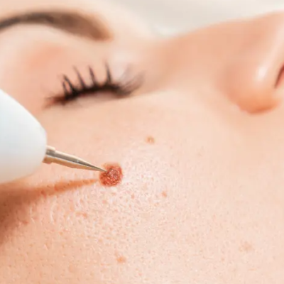 Mole Removal Treatment