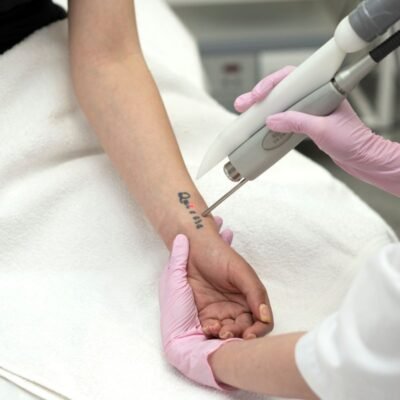 Laser Tattoo Removal